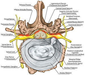 A Revolution in Treating Herniated Discs: 3 Benefits of Taking a Non ...